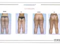 Endermologia: Jak często, ile zabiegów? Ekspert radzi!