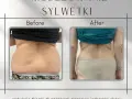 Liposukcja: Modelowanie sylwetki i trwałe efekty. Czy to dla Ciebie?
