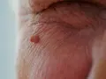 Zbliżenie na skórę z widoczną brodawką. Różne brodawki na twarzy mogą mieć odmienny wygląd.