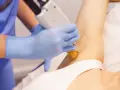 Czy depilacja laserowa boli? Mniej niż myślisz! Porównanie i porady