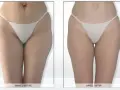 Endermologia: Gładka skóra i wymodelowana sylwetka bez skalpela?