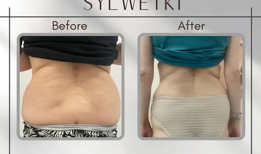 Liposukcja: Modelowanie sylwetki i trwałe efekty. Czy to dla Ciebie?