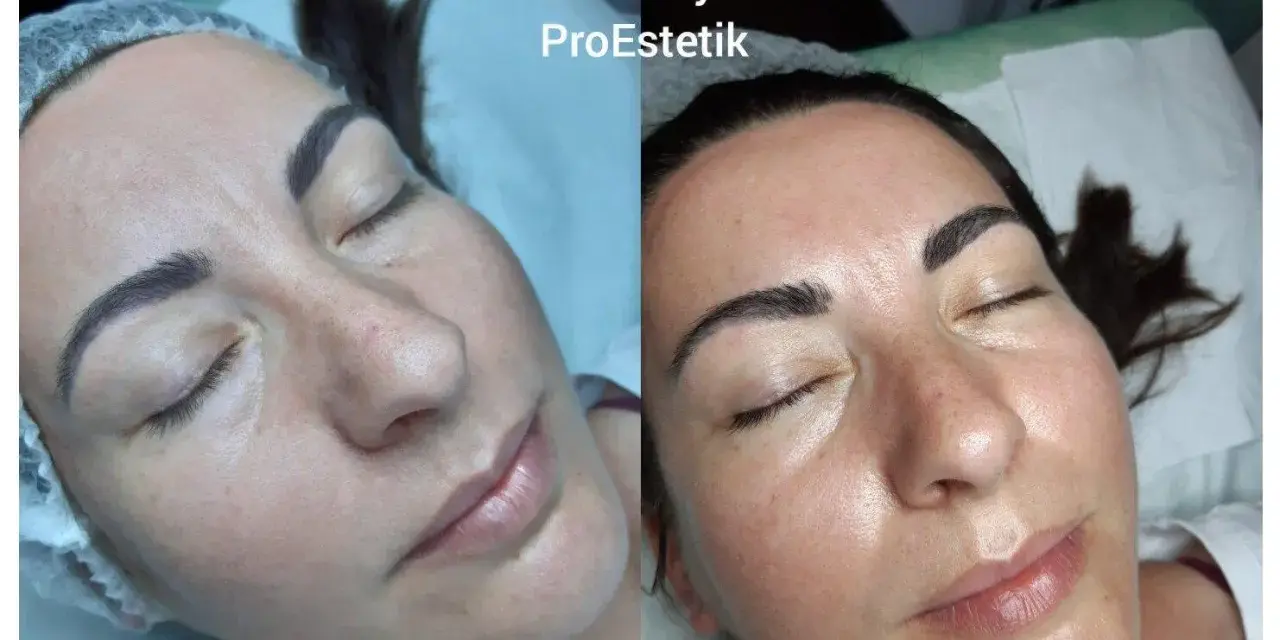 Przed i po zabiegu: twarz po oczyszczaniu wodorowym wygląda promiennie i świeżo.