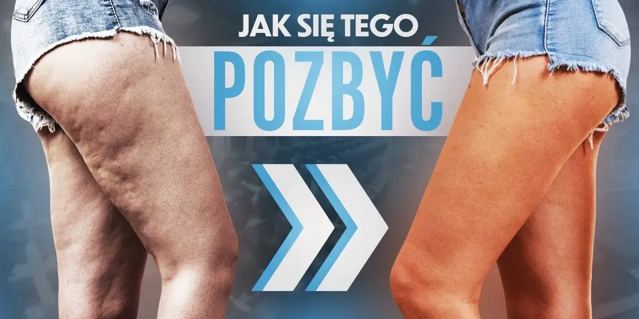 Cellulit na nogach: jak się go pozbyć? Kompleksowy poradnik
