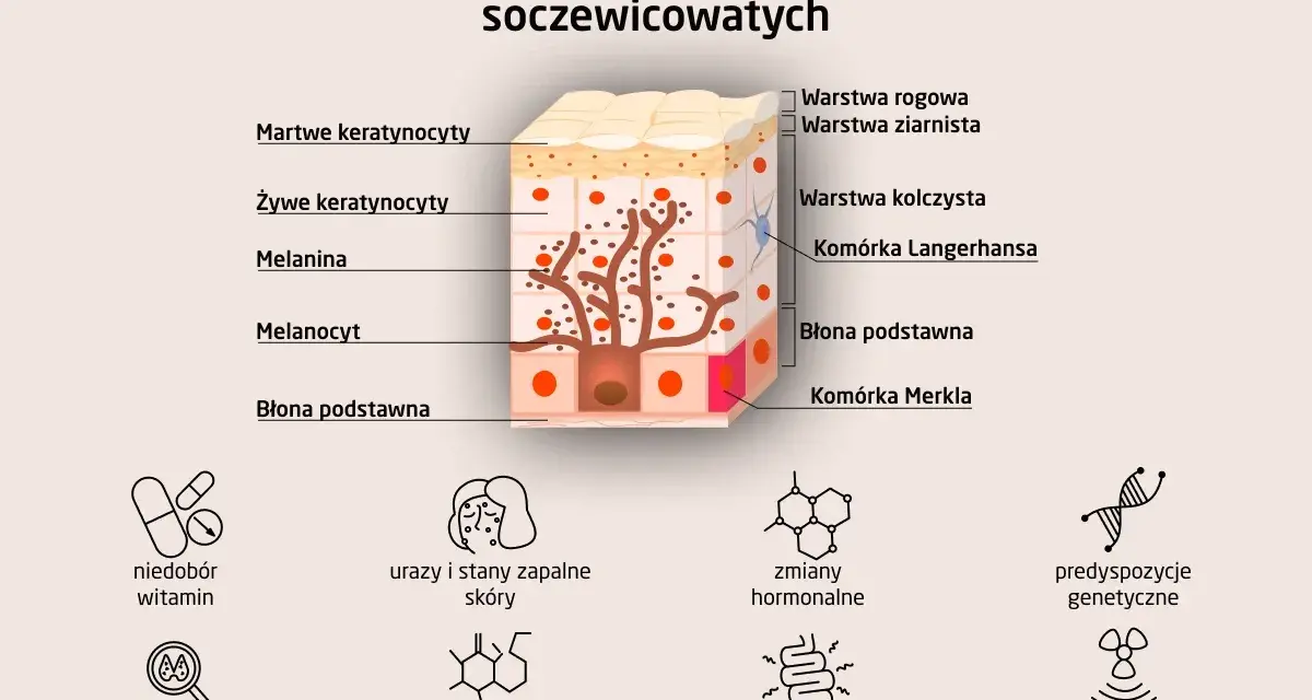 Schemat przedstawia budowę skóry i przyczyny powstawania plam soczewicowatych, takich jak niedobór witamin, zmiany hormonalne czy ekspozycja na promienie UV.