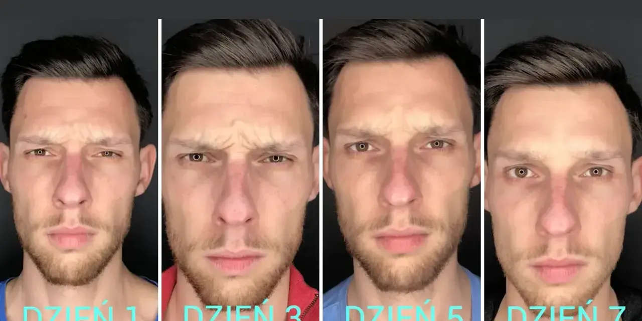 Kiedy efekty po botoksie? Od 2 dni do 6 miesięcy pełen harmonogram