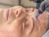 Zabieg mezoterapii mikroigłowej w trakcie. Skóra zaczerwieniona, widoczne drobne nakłucia. Warto znać mezoterapia mikroigłowa przeciwwskazania.