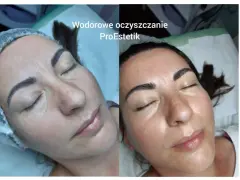 Przed i po zabiegu: twarz po oczyszczaniu wodorowym wygląda promiennie i świeżo.