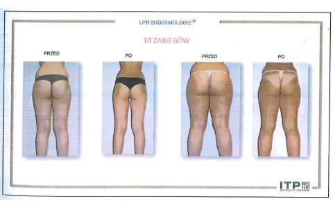 Endermologia: Jak często, ile zabiegów? Ekspert radzi!