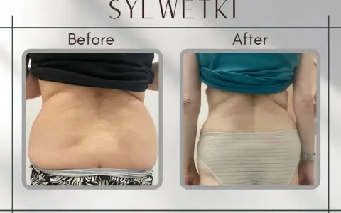 Liposukcja: Modelowanie sylwetki i trwałe efekty. Czy to dla Ciebie?