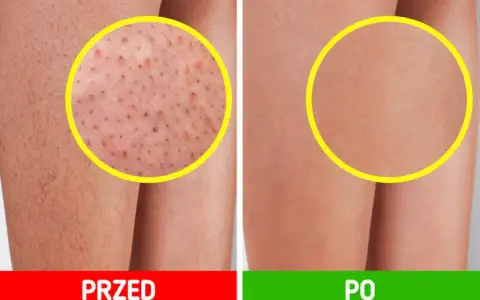 Jak pożegnać „truskawkowe nogi”? Gładka skóra po goleniu!
