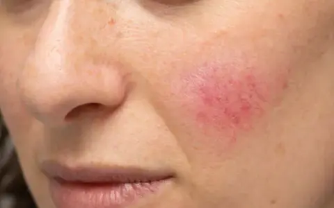 Cera naczynkowa: Jak rozpoznać objawy i co czuje Twoja skóra?