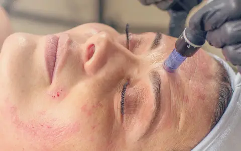 Zabieg mezoterapii mikroigłowej w trakcie. Skóra zaczerwieniona, widoczne drobne nakłucia. Warto znać mezoterapia mikroigłowa przeciwwskazania.