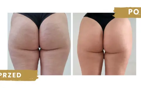 Jak pozbyć się cellulitu z brzucha? Domowe sposoby i zabiegi!