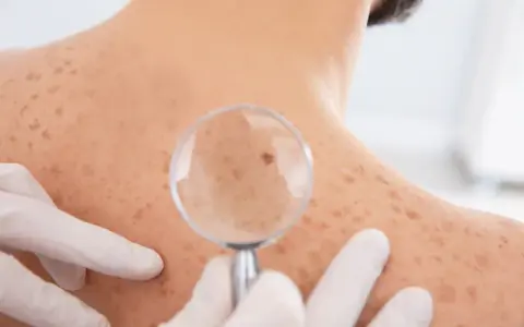 Dermatolog bada znamię na plecach pacjenta przez lupę. Skóra pokryta jest licznymi piegami i znamionami.