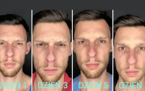 Kiedy efekty po botoksie? Od 2 dni do 6 miesięcy pełen harmonogram