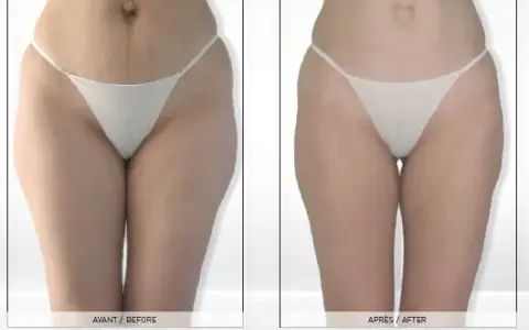 Endermologia: Gładka skóra i wymodelowana sylwetka bez skalpela?