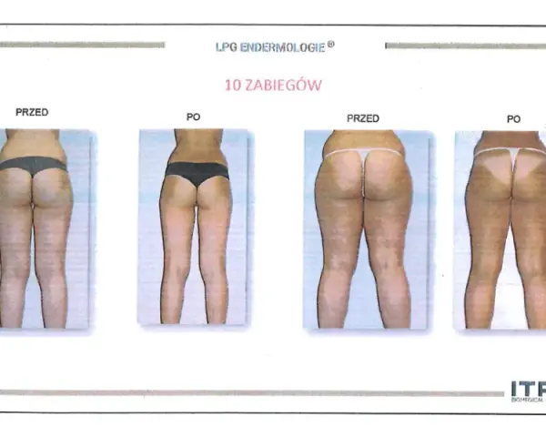 Endermologia: Jak często, ile zabiegów? Ekspert radzi!