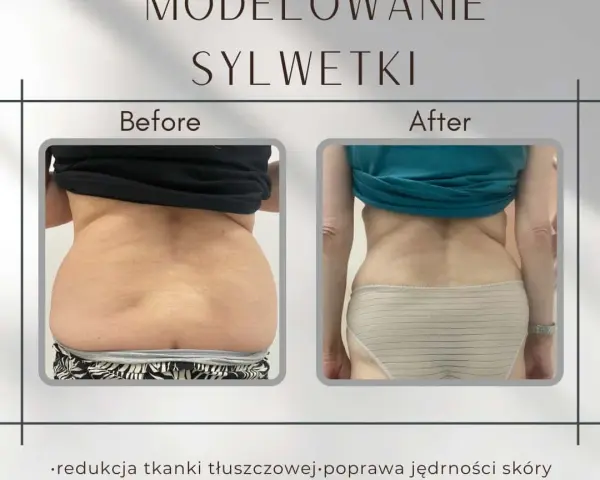 Liposukcja: Modelowanie sylwetki i trwałe efekty. Czy to dla Ciebie?