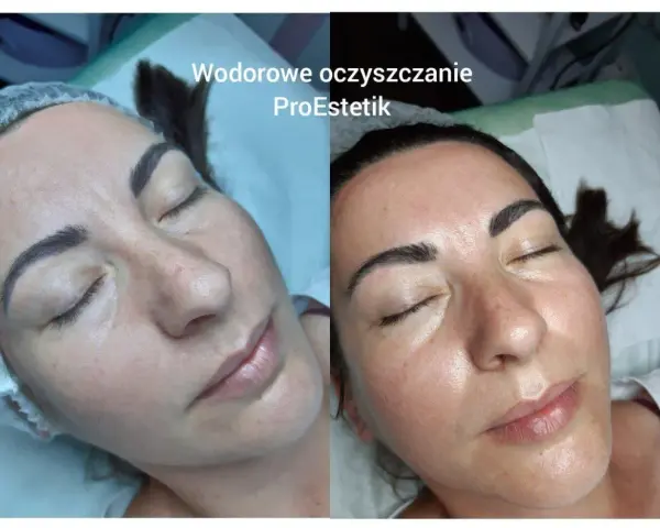 Przed i po zabiegu: twarz po oczyszczaniu wodorowym wygląda promiennie i świeżo.