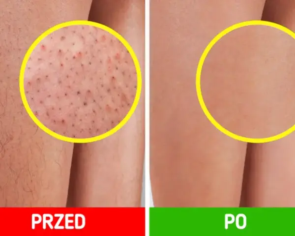 Jak pożegnać „truskawkowe nogi”? Gładka skóra po goleniu!
