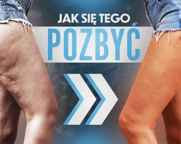 Cellulit na nogach: jak się go pozbyć? Kompleksowy poradnik