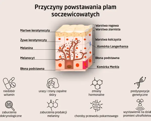 Schemat przedstawia budowę skóry i przyczyny powstawania plam soczewicowatych, takich jak niedobór witamin, zmiany hormonalne czy ekspozycja na promienie UV.
