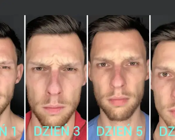 Kiedy efekty po botoksie? Od 2 dni do 6 miesięcy pełen harmonogram