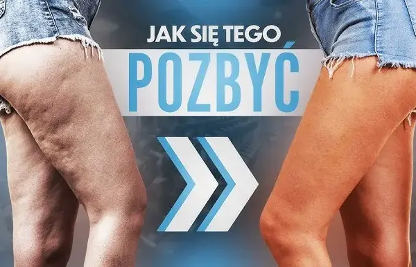 Jak pozbyłam się cellulitu? Mój kompleksowy plan krok po kroku