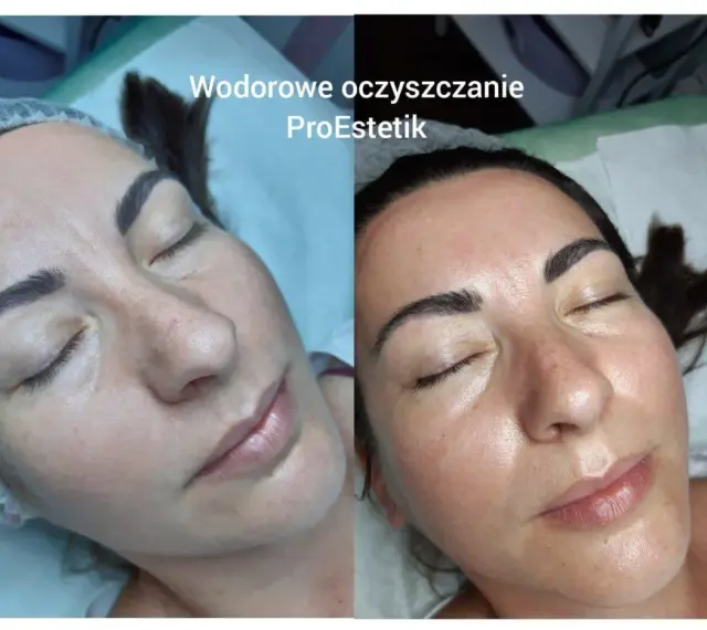 Przed i po zabiegu: twarz po oczyszczaniu wodorowym wygląda promiennie i świeżo.