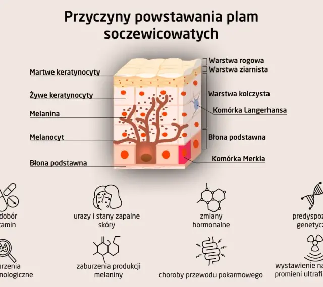 Schemat przedstawia budowę skóry i przyczyny powstawania plam soczewicowatych, takich jak niedobór witamin, zmiany hormonalne czy ekspozycja na promienie UV.