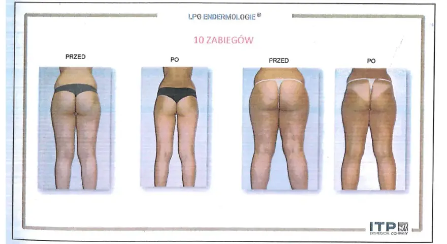 Endermologia: Jak często, ile zabiegów? Ekspert radzi!