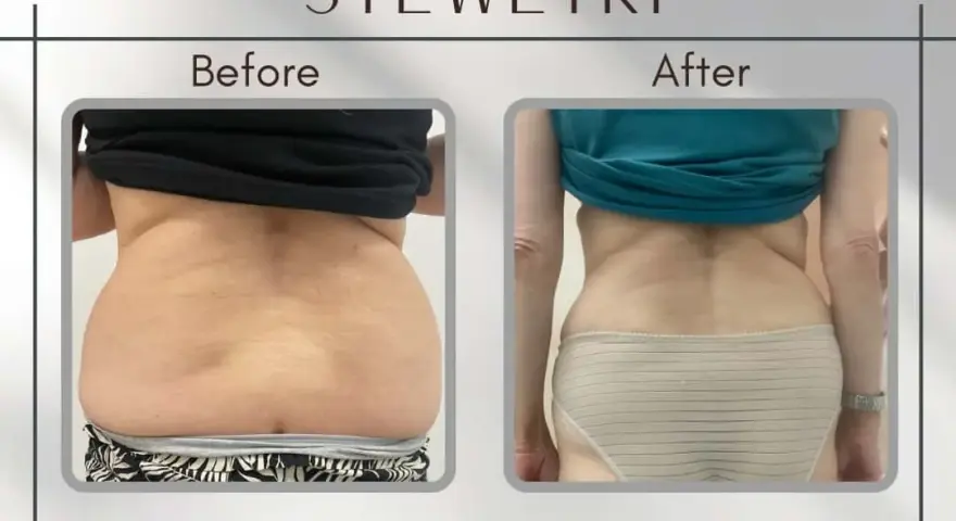Liposukcja: Modelowanie sylwetki i trwałe efekty. Czy to dla Ciebie?