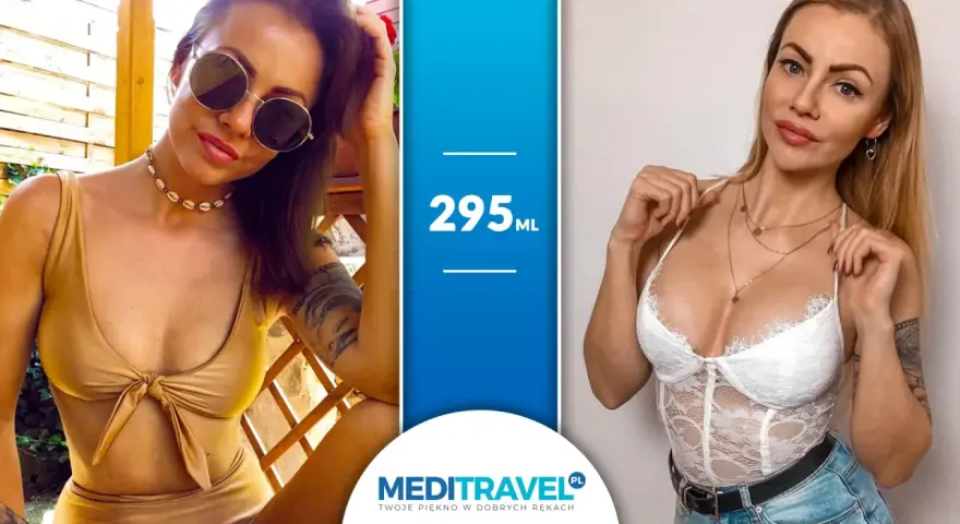 Kobiety prezentujące efekt powiększenia piersi implantami 295 ml. Dwie kobiety w strojach kąpielowych i bieliźnie, podkreślające swoje nowe kształty.