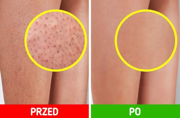 Jak pożegnać „truskawkowe nogi”? Gładka skóra po goleniu!