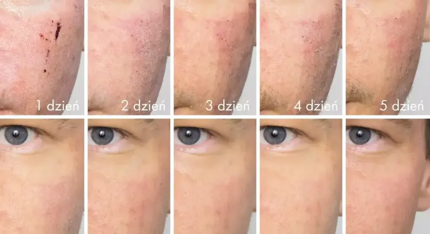 Postęp gojenia skóry po depilacji laserowej: od strupków i zaczerwienienia w 1. dniu do wygojenia w 10. dniu.