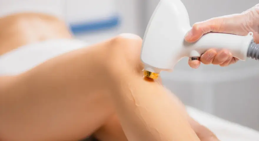 Depilacja laserowa nóg: Ile zabiegów dla gładkiej skóry na lata?
