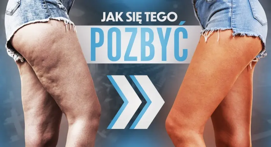 Cellulit na nogach: jak się go pozbyć? Kompleksowy poradnik