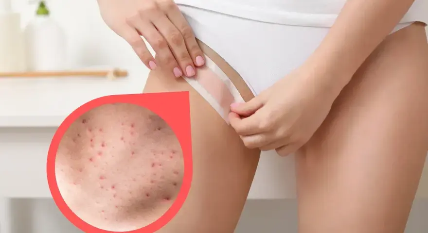 Zbliżenie na skórę z krostami po goleniu bikini. Dowiedz się, co na krosty po goleniu bikini pomoże.