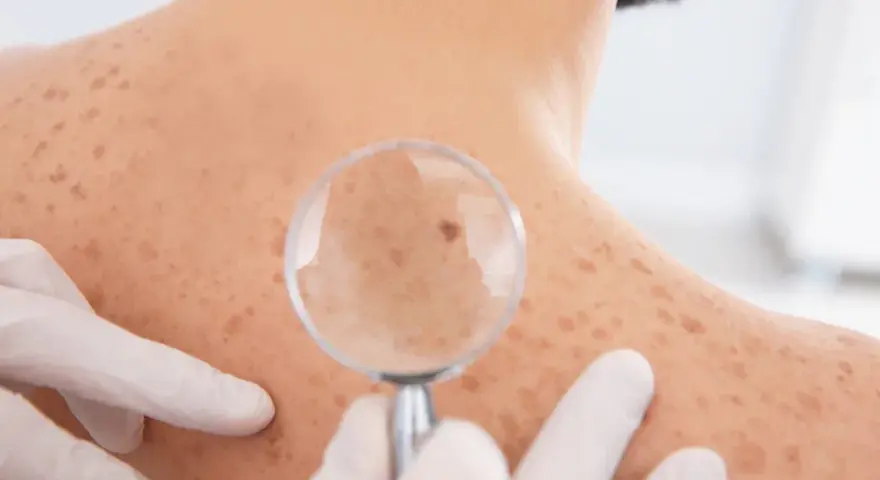 Dermatolog bada znamię na plecach pacjenta przez lupę. Skóra pokryta jest licznymi piegami i znamionami.