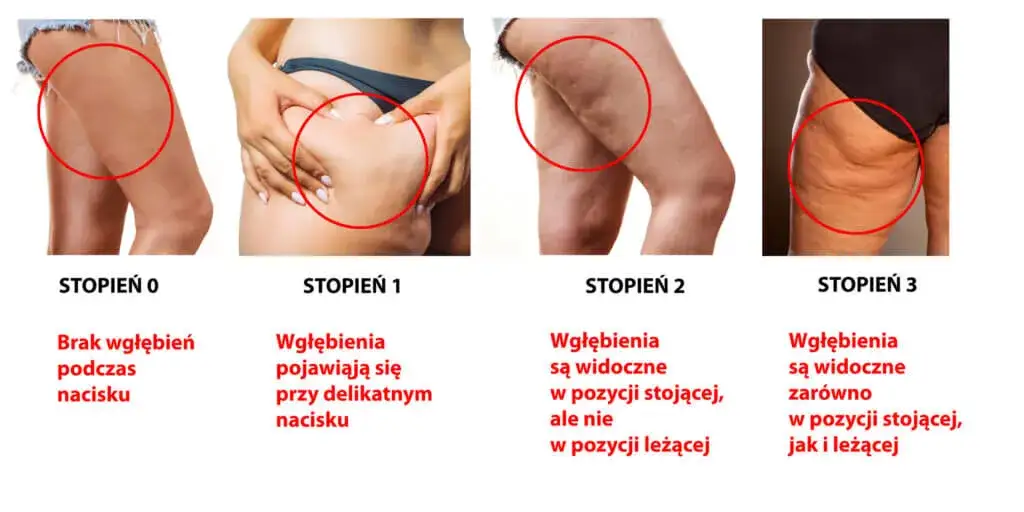 Rodzaje cellulitu porównanie