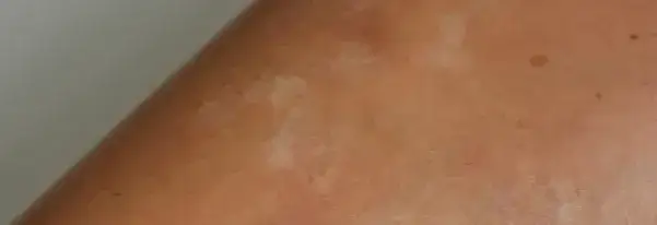Skutki opalania po depilacji laserowej - przebarwienia i oparzenia