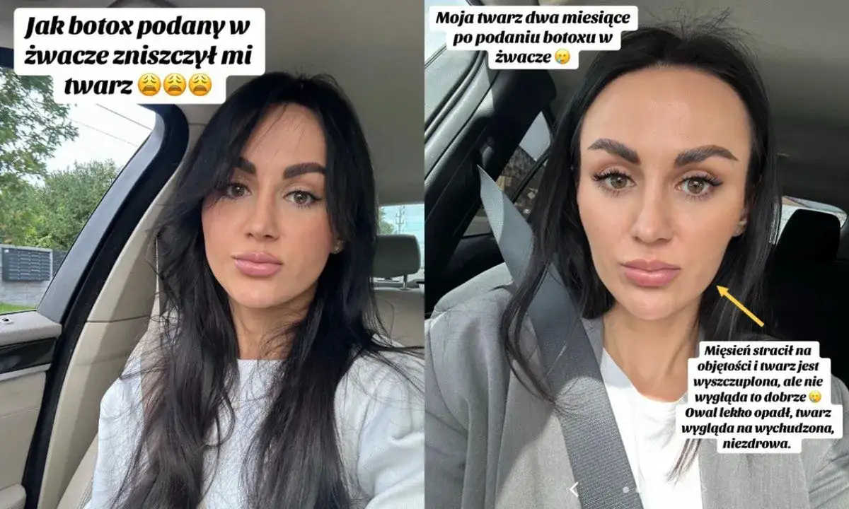 kobieta zrelaksowana twarz po botoksie