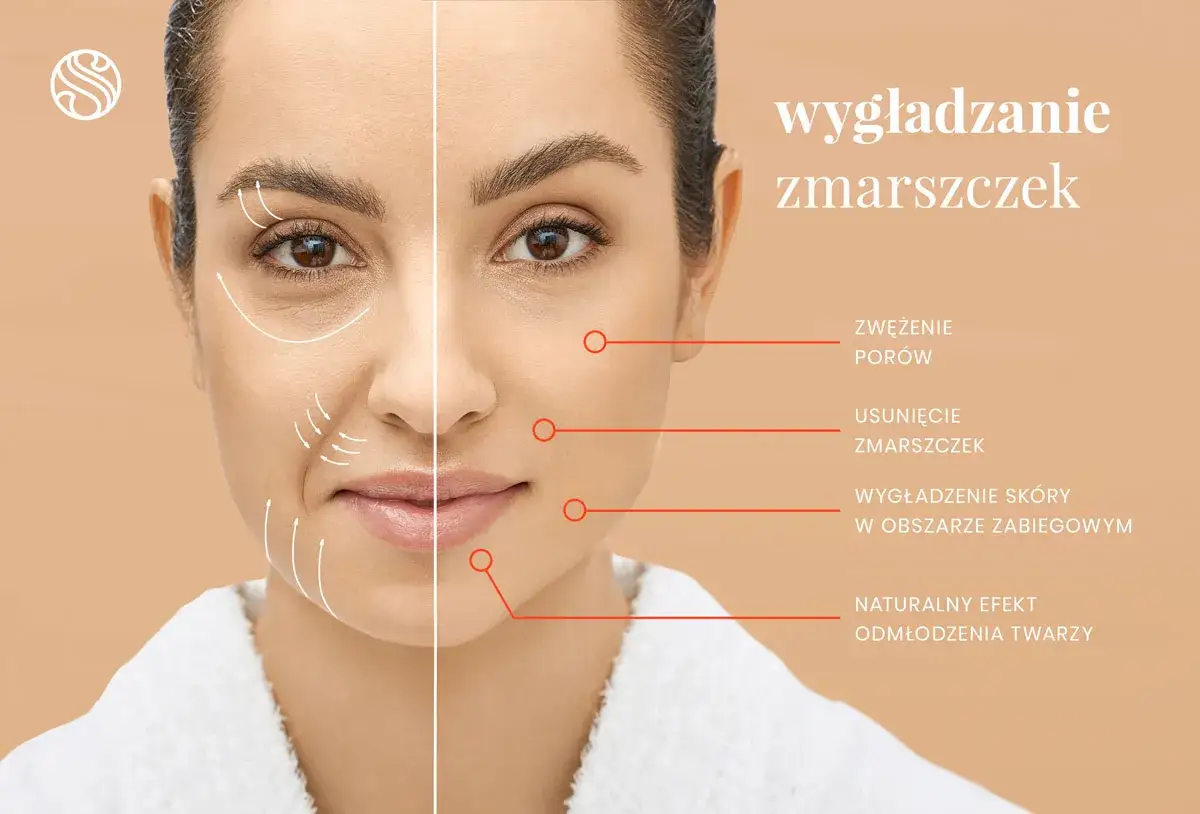 Kobieta z widocznymi zmarszczkami mimicznymi po jednej stronie twarzy, po drugiej wygładzona skóra. Efekt odmłodzenia.