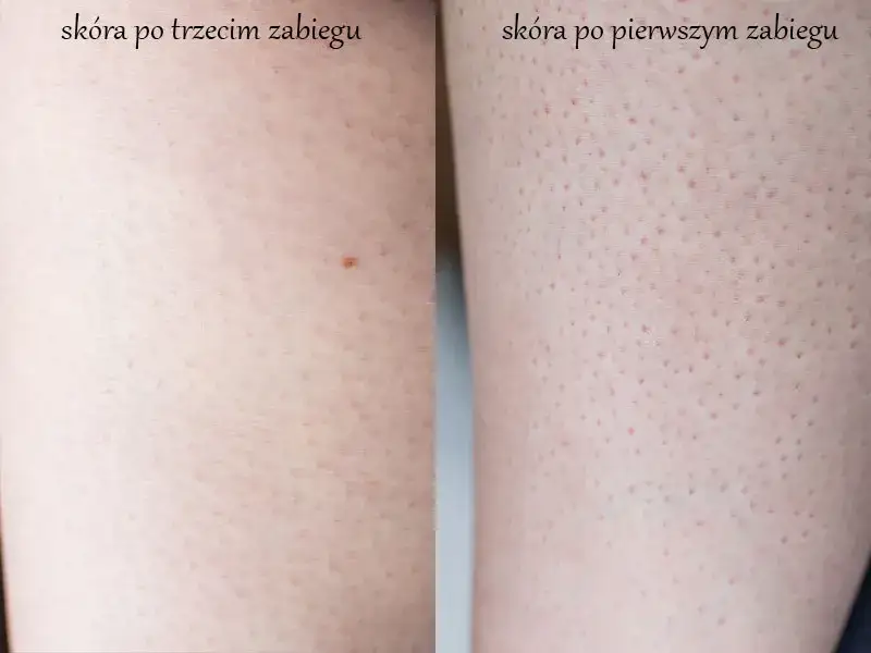 Depilacja laserowa nóg przed i po efekty