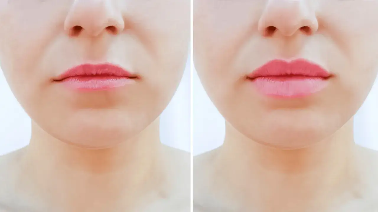 Botox usta przed po lip flip zmarszczki palacza