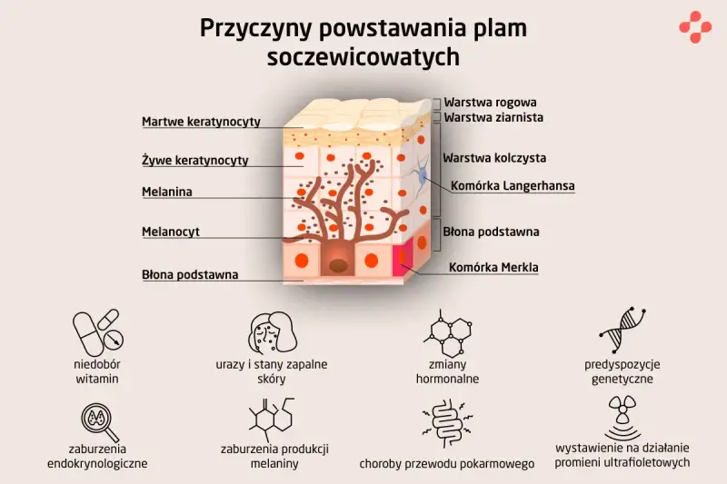 Schemat przedstawia budowę skóry i przyczyny powstawania plam soczewicowatych, takich jak niedobór witamin, zmiany hormonalne czy ekspozycja na promienie UV.